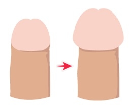 東京上野クリニックの亀頭増大術